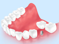 インプラントとは